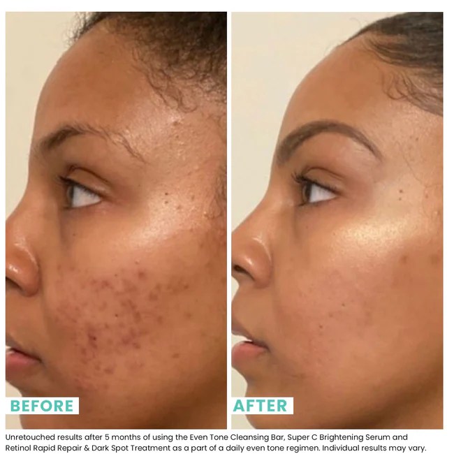 Beat Skin Breakouts With This Acne Serum